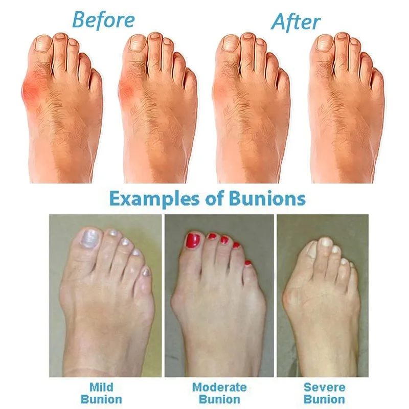 Orthopedic Sandals with Bunion Support Slip-On Design